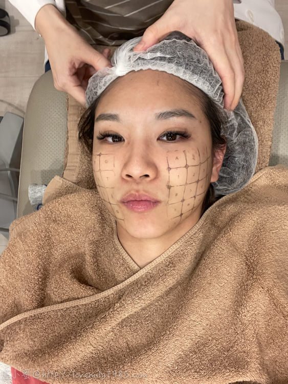【醫美】超級厲害維持將近兩年的鳳凰電波！